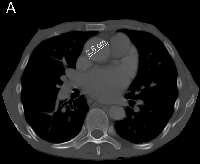 Examples of cardiovascular chest CT findings